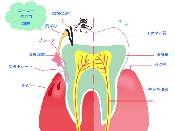 虫歯は自然に治りません