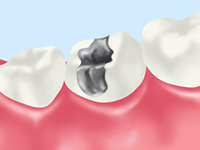 詰め物・被せ物の隙間